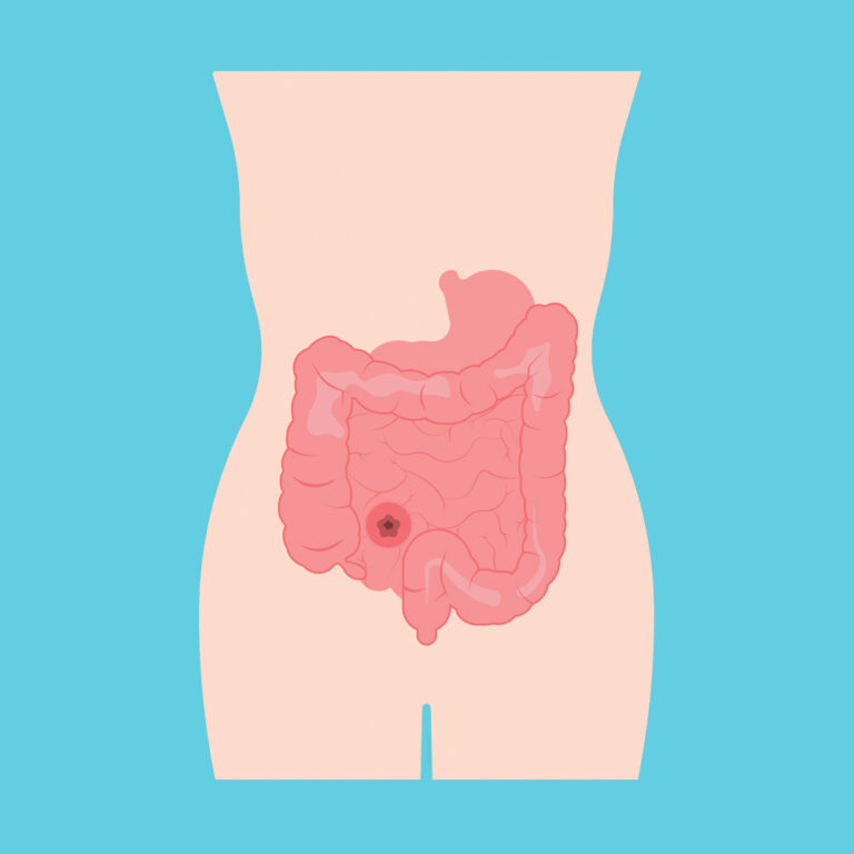 What Is A Stoma Stoma Hub What is a stoma stoma hub